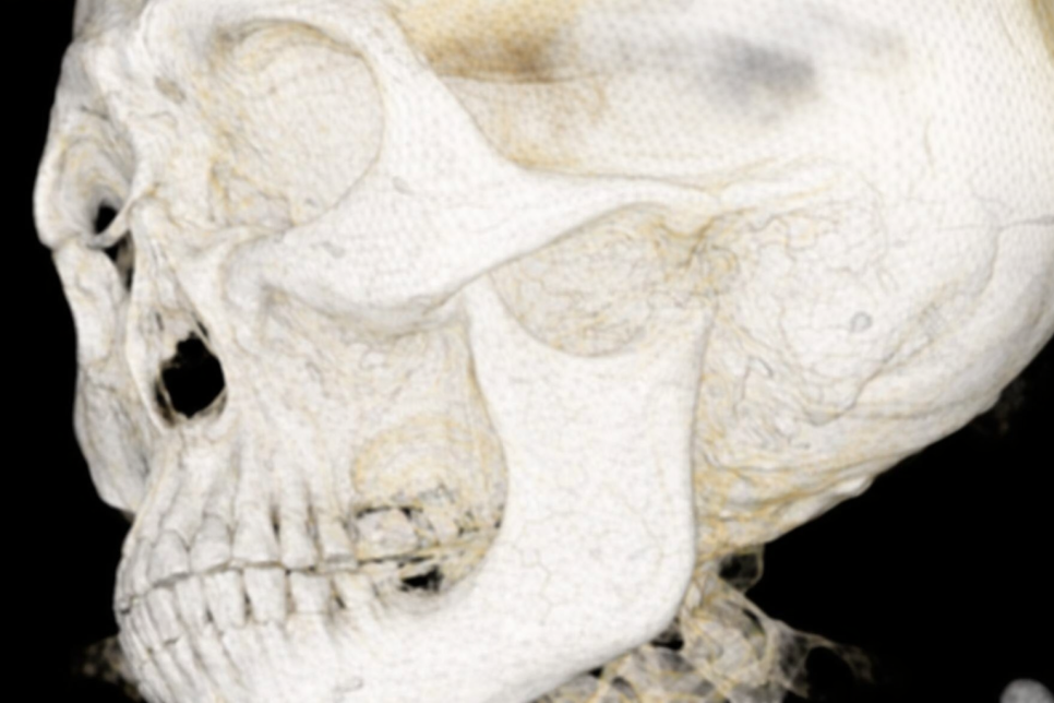 선유도역 치과 네이게이션 임플란트, 어떻게 진행될까? 관련 이미지 2