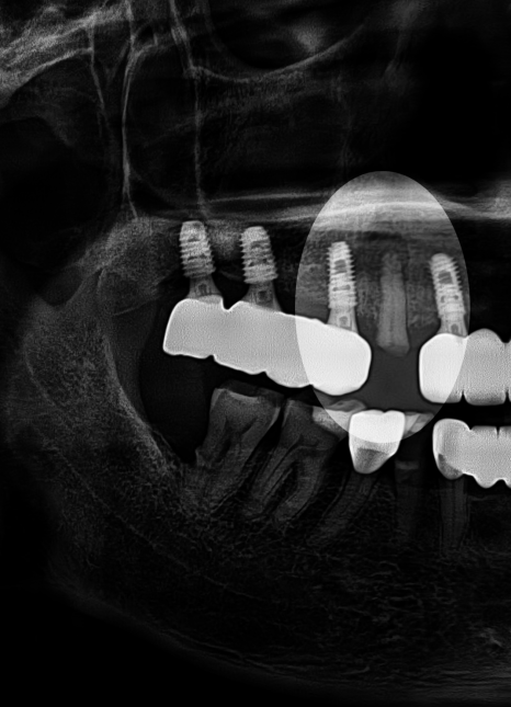 당산동 치과 앞니 파절 : 치관확장술이 필요할 수 있습니다. 관련 이미지 4