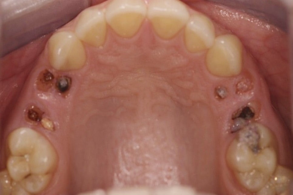영등포구청역 치과 치아 상실 시 발생할 수 있는 구강 내 문제점은 무엇이 있을까? 관련 이미지 2