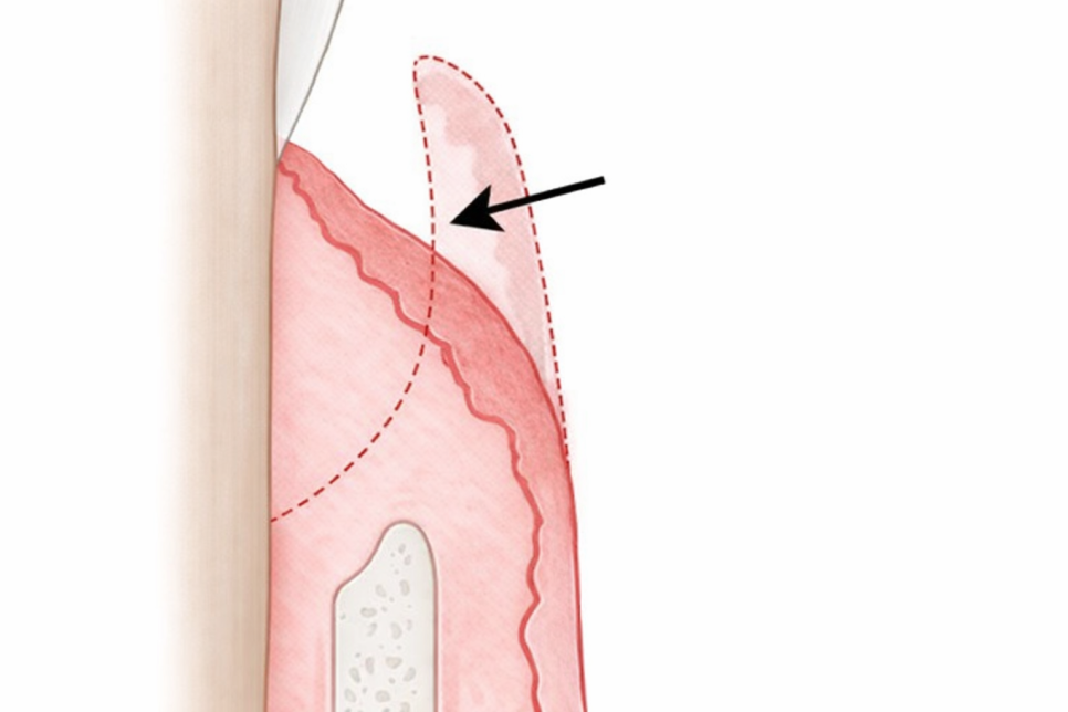 당산동 치과 잇몸치료! 치근활택술 / 치주소파술이란? 관련 이미지 5