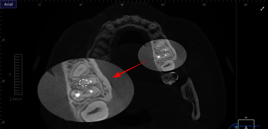 당산동 치과 미세현미경을 활용한 재신경치료 : MB2 근관을 찾아라! 관련 이미지 1