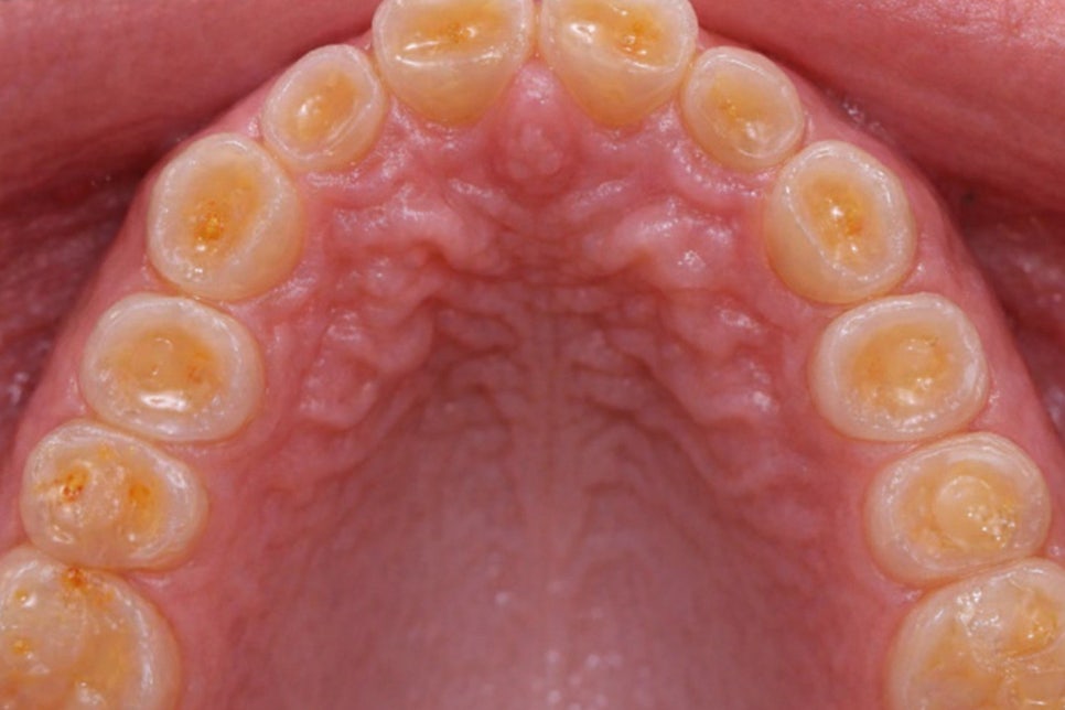 이갈이 & 이 악물기 예방 당산 턱관절 치과 보톡스 및 스플린트 관련 이미지 2