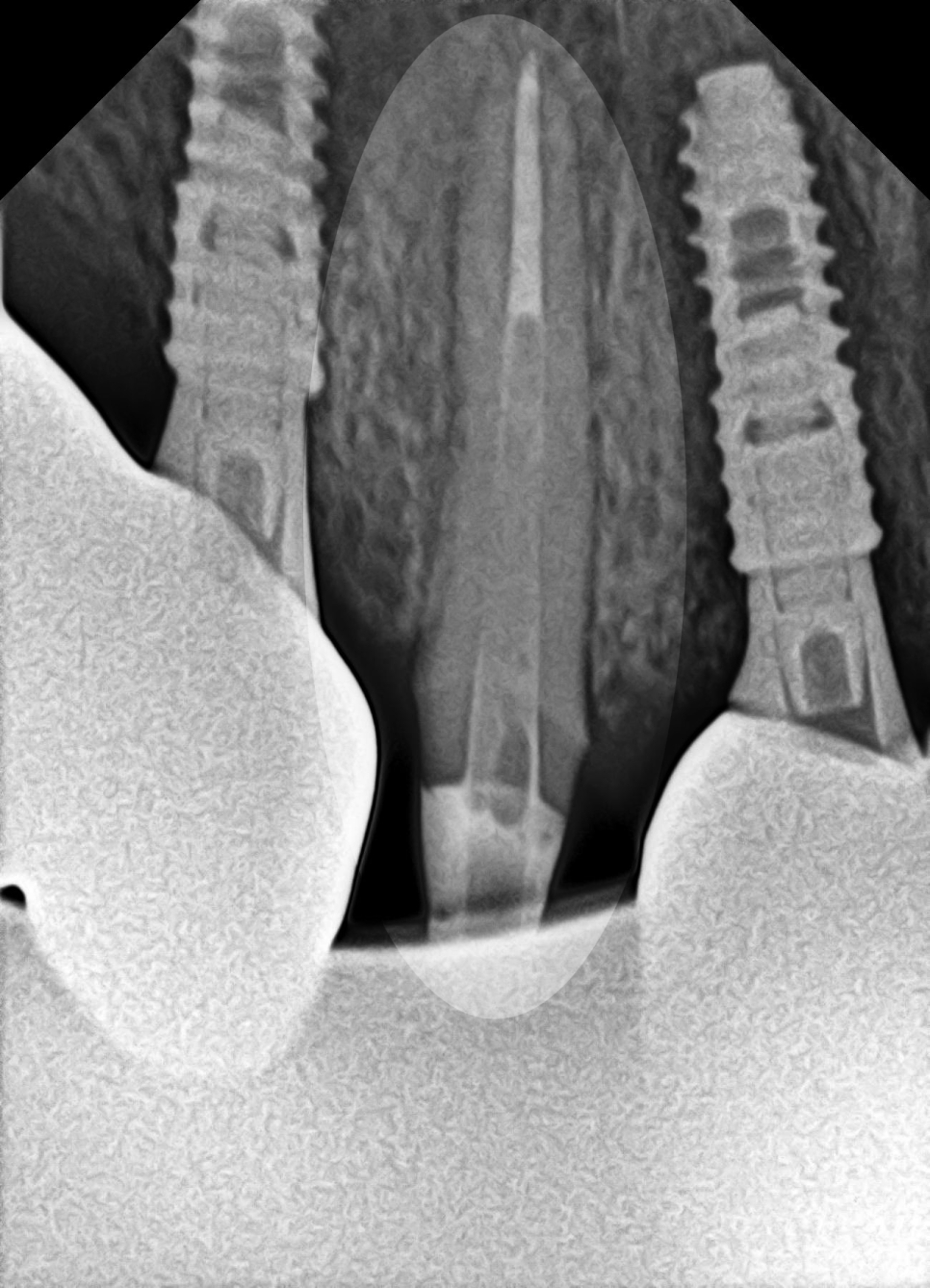 당산동 치과 앞니 파절 : 치관확장술이 필요할 수 있습니다. 관련 이미지 6