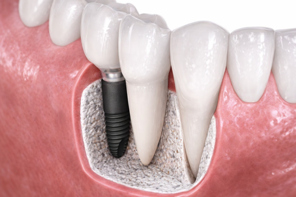 선유도역 치과 임플란트 성공을 방해하는 요소 ft. 하중부하, 픽스처 표면 처리 및 흡연 관련 이미지 2