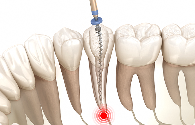 Why a Tooth Crown Is Needed After Root Canal Treatment at a Dental Clinic Near Yeongdeungpo-gu Office Station image 1