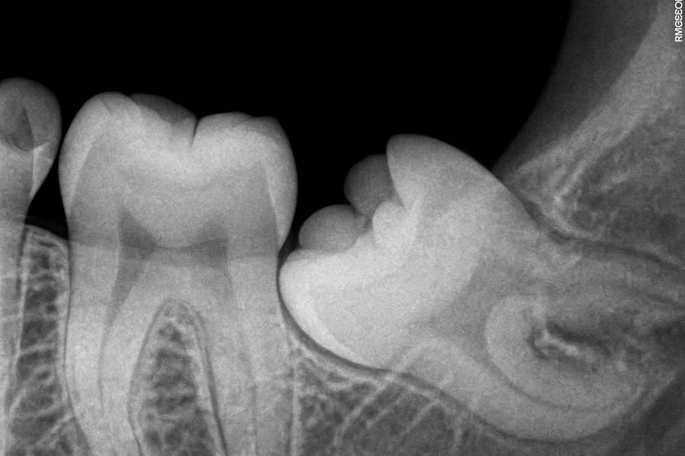 연세초록빛 치과 , 치아 진료 시 환자들이 궁금해하는 질문: 엑스레이(X-ray) 촬영은 왜 필요할까? 관련 이미지 6