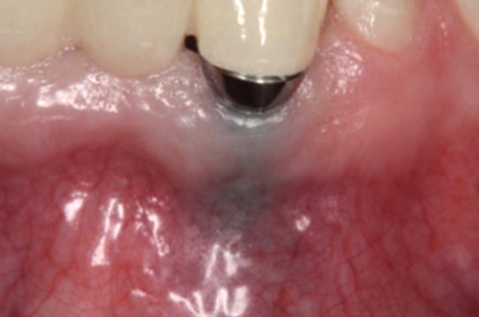 임플란트 관리가 더욱 중요한 이유! 생활 습관으로 달라질 수 있는 보철의 수명 : 당산 치과 관련 이미지 2