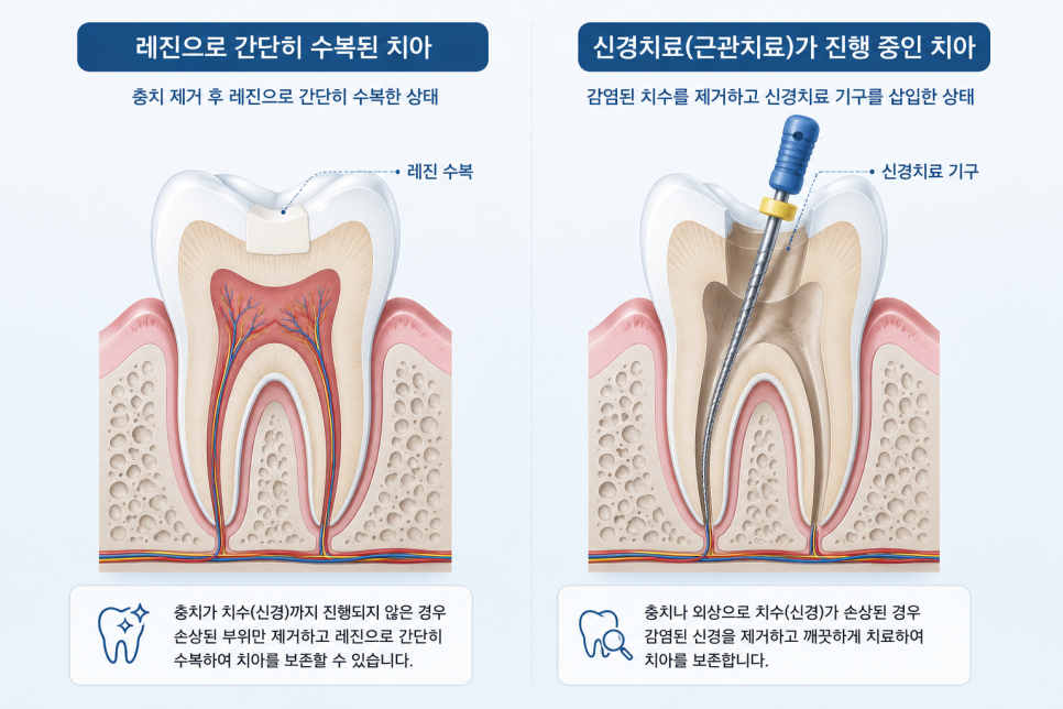 Does a Tooth Fracture at a Dangsan-dong Dental Clinic Always Require Root Canal Treatment? image 3