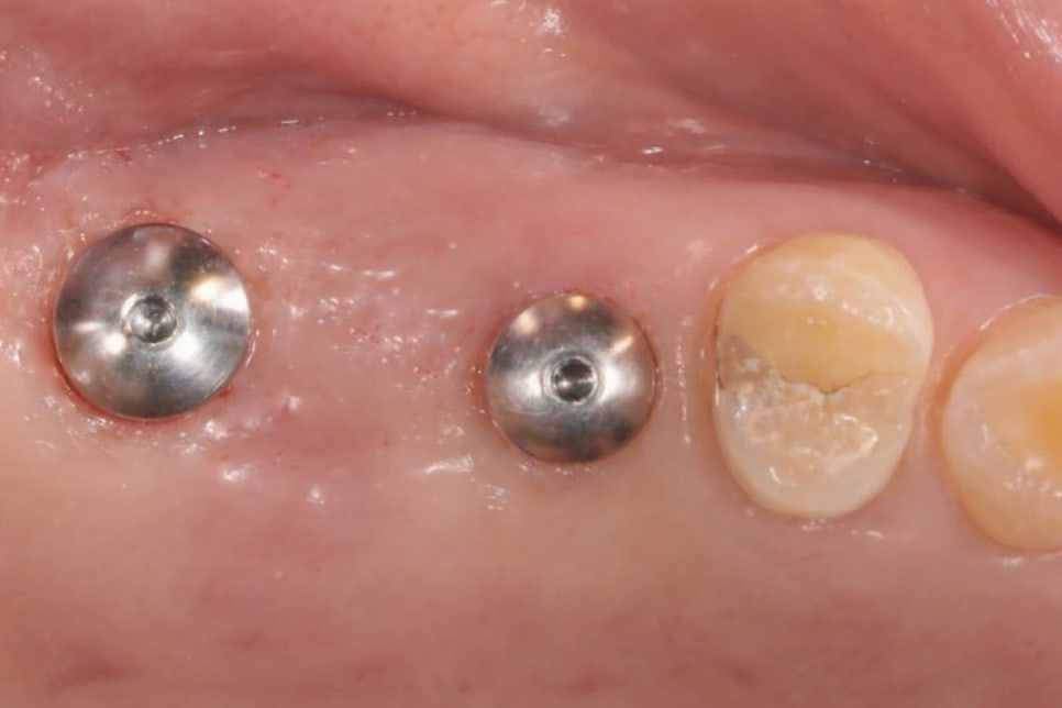 잇몸을 열지 않아 회복이 빠른 무절개 임플란트 당산역 치과 에서 flapless implant 장점에 대해 알려드립니다. 관련 이미지 4