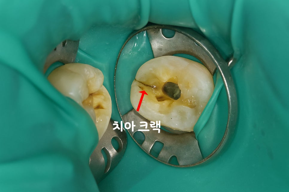 당산역 치과 : 보이지 않는 신경을 찾는 방법, 치아 치료 시 사용하는 미세현미경 관련 이미지 5