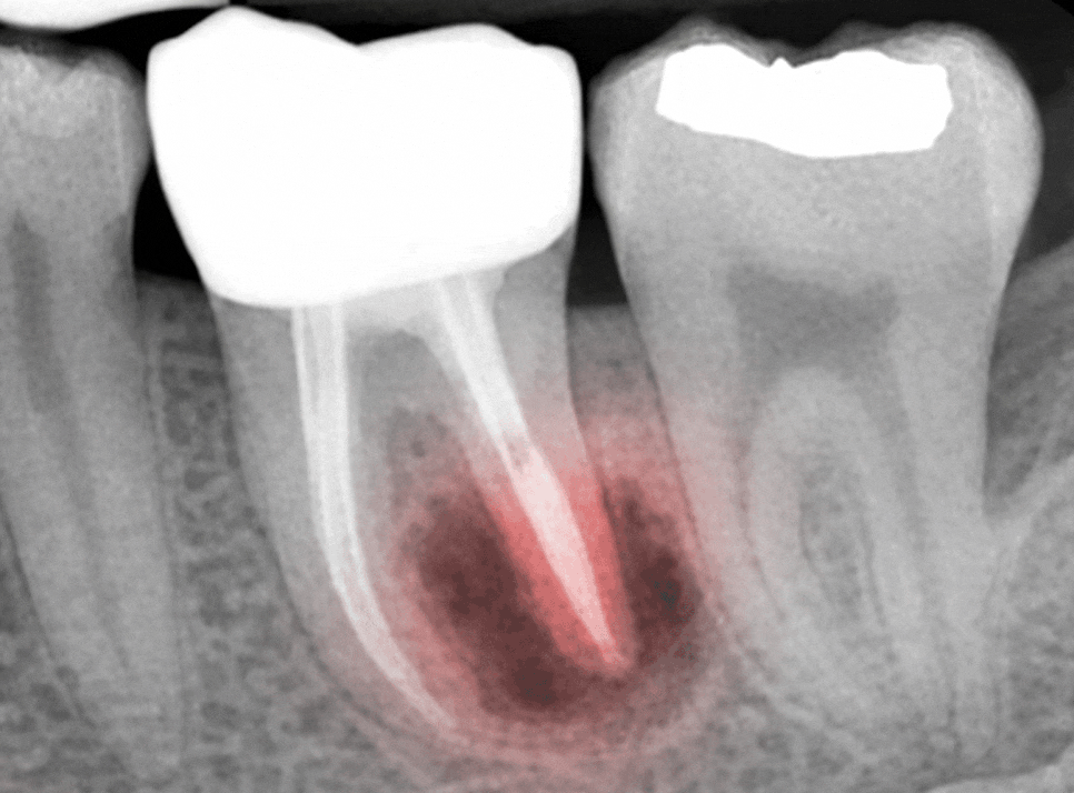 선유도 치과 재신경치료! 점점 커지는 치아 뿌리 염증 잡는 방법 관련 이미지 5