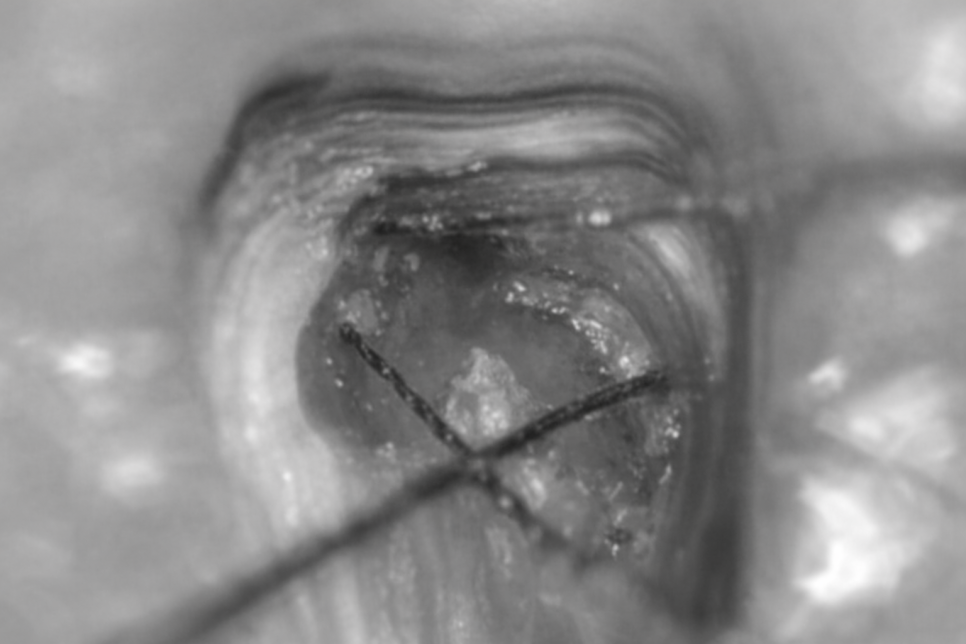 치아 파절 & 신경치료, 왜 당산동 치과 미세현미경 필요할까? 관련 이미지 4