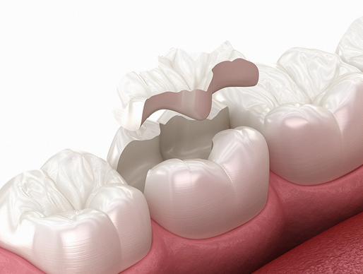 Tooth Treated at Dangsan Station Dental Clinic Has Another Cavity? This Is How Secondary Caries Begins. image 1