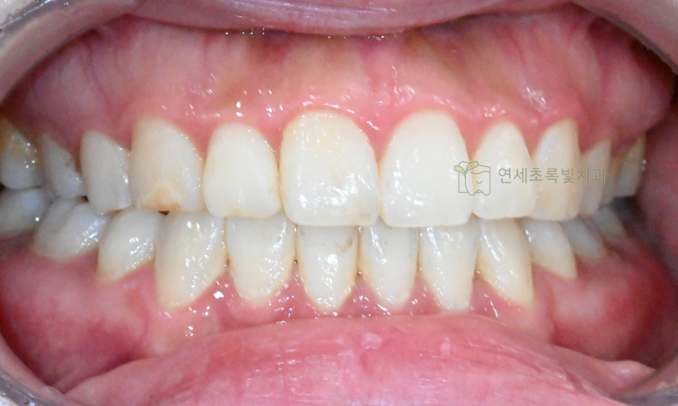 당산동 치과 원데이 화이트닝, 미백 치약보다 효능 확실한 이유는?! 관련 이미지 1