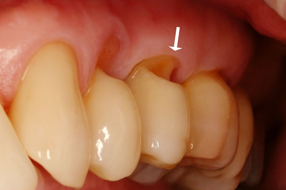 당산동 치과 : 레진 치료가 필요한 상황은 언제일까요? 초기 우식 & 앞니 벌어짐 & 파절 등 관련 이미지 6
