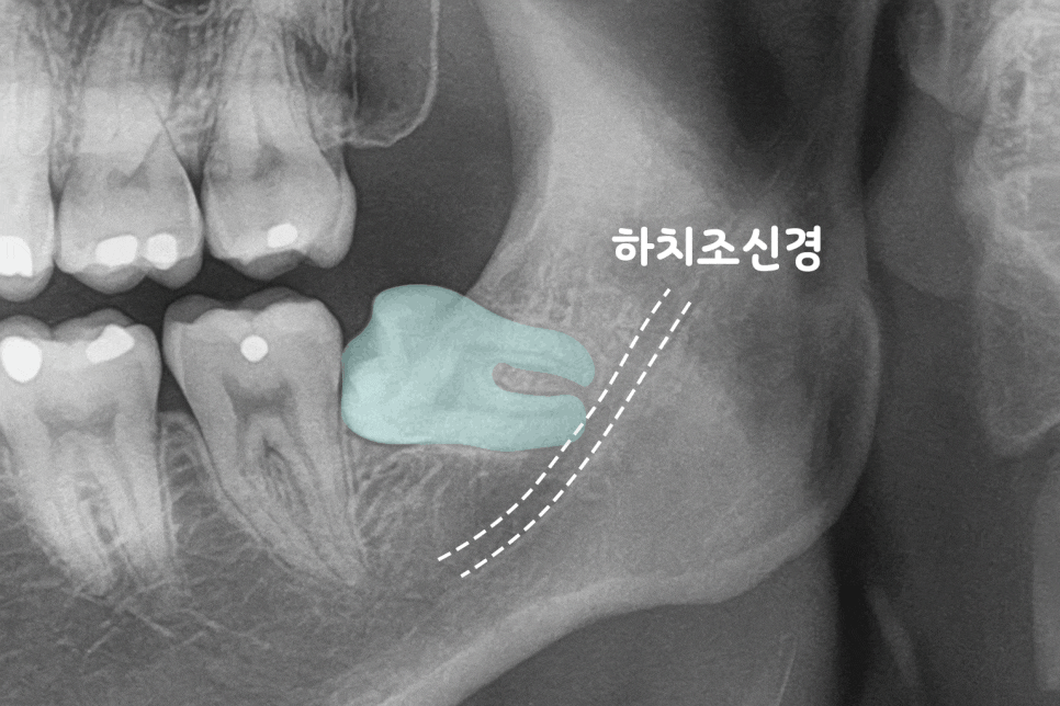 선유도역 치과 : 사랑니 발치 후 생길 수 있는 합병증, 어떻게 예방할 수 있을까? 관련 이미지 9