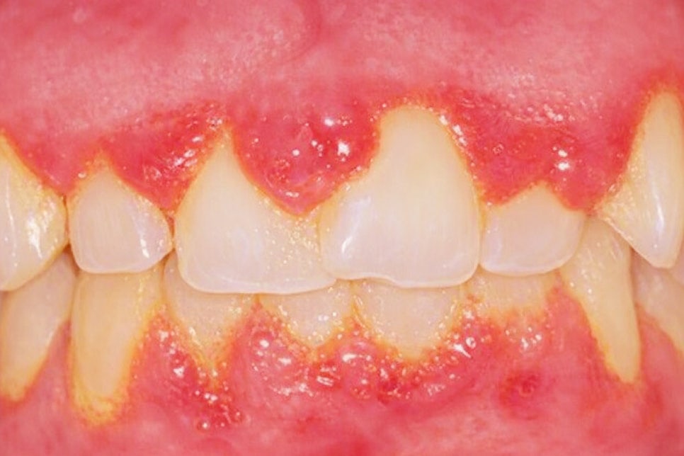 당산동 치과 임산부 치아 치료 시기별 주의해야 될 점 및 보험 혜택 관련 이미지 2