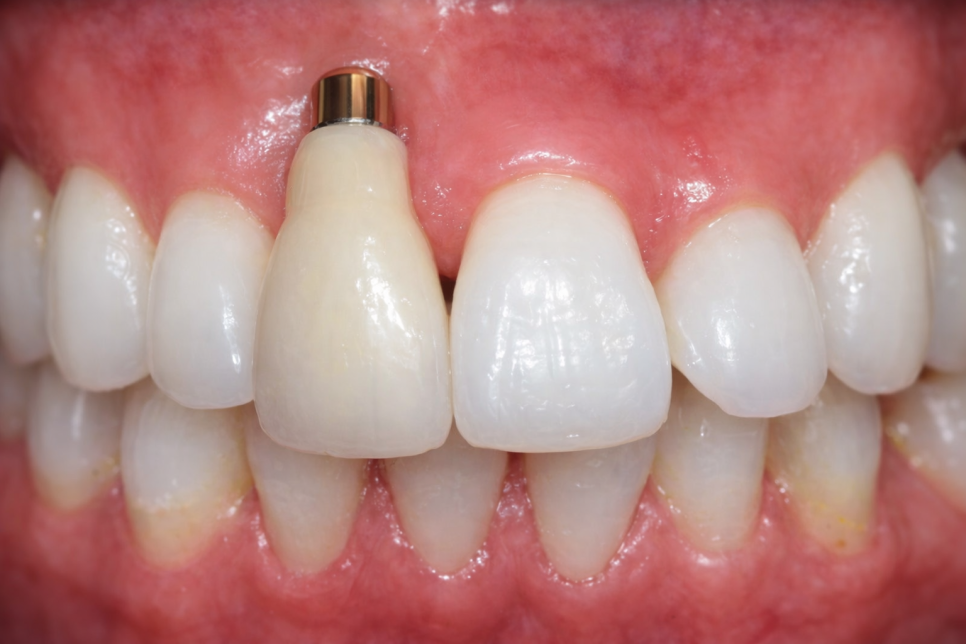 선유도역 치과 임플란트 성공을 방해하는 요소 ft. 하중부하, 픽스처 표면 처리 및 흡연 관련 이미지 5