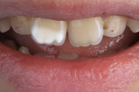 당산역 치과 아이콘 레진이란? : 치아 탈회 및 교정 치료 후 화이트 스팟 관련 이미지 1