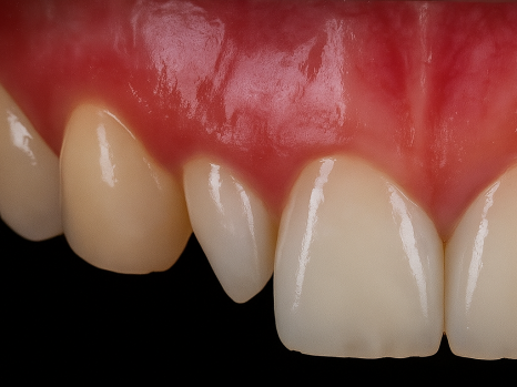 선유도역 치과 왜소치 라미네이트 VS 레진 수복 적합한 치료는?! 관련 이미지 5