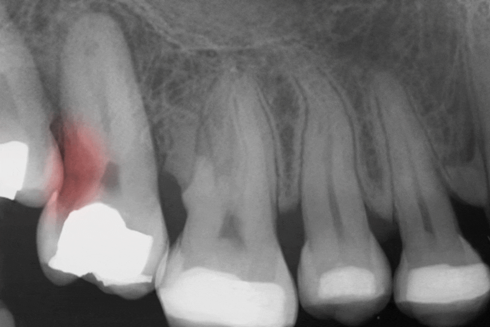 보철 밑에서 조용히 진행되는 2차 우식 - 레진 & 크라운 변연 미세누출 , 당산역 치과 관련 이미지 3