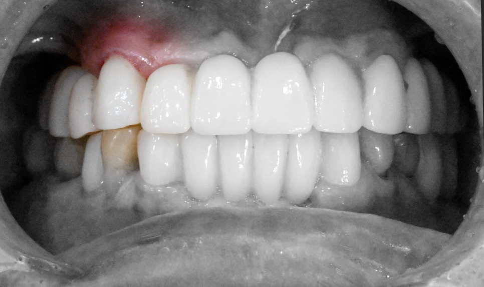 당산동 치과 앞니 파절 : 치관확장술이 필요할 수 있습니다. 관련 이미지 10