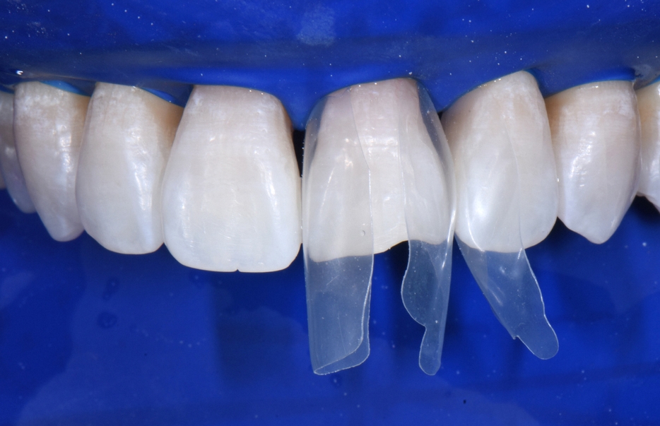Dangsan-dong Dental Clinic: Were You Disappointed with Your Front Tooth Composite Result? Anterior Tooth Restoration Using the BioClear Matrix image 3