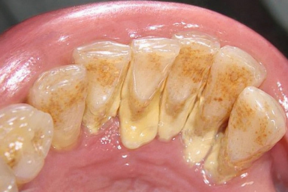 당산 치과 치은연하치석이란? 주기적으로 스케일링 받아야 되는 이유! 관련 이미지 2