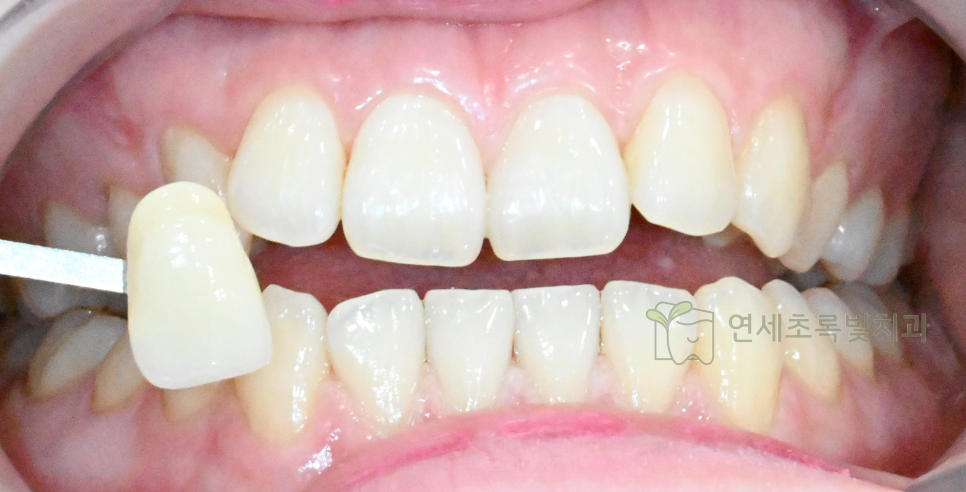당산동 치과 원데이 화이트닝, 미백 치약보다 효능 확실한 이유는?! 관련 이미지 3