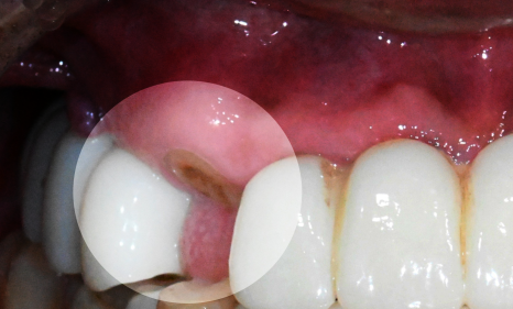 당산동 치과 앞니 파절 : 치관확장술이 필요할 수 있습니다. 관련 이미지 7