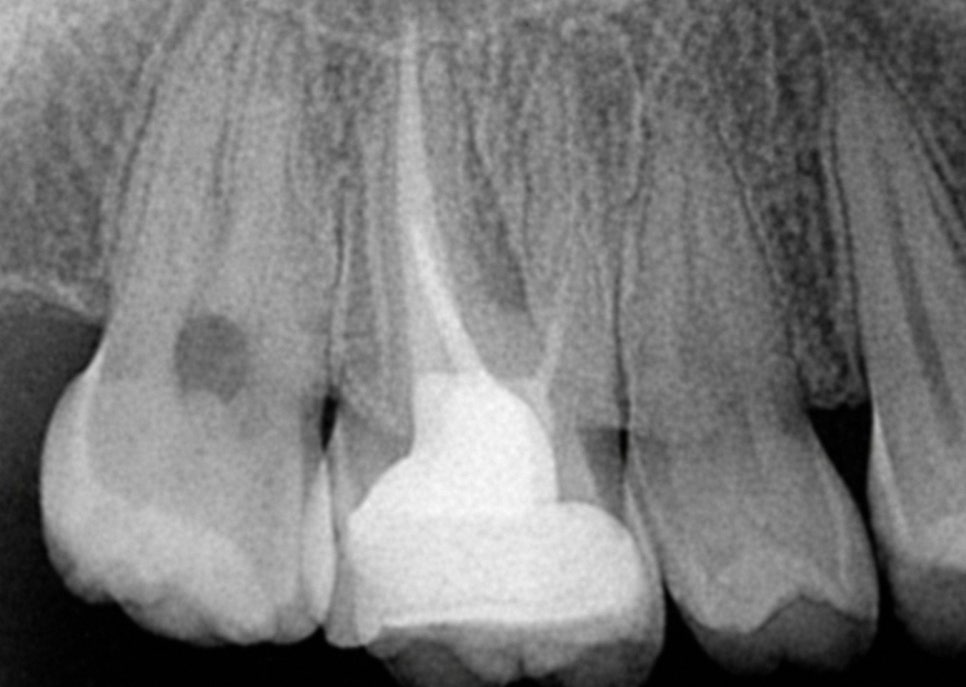 선유도 치과 재신경치료! 점점 커지는 치아 뿌리 염증 잡는 방법 관련 이미지 6
