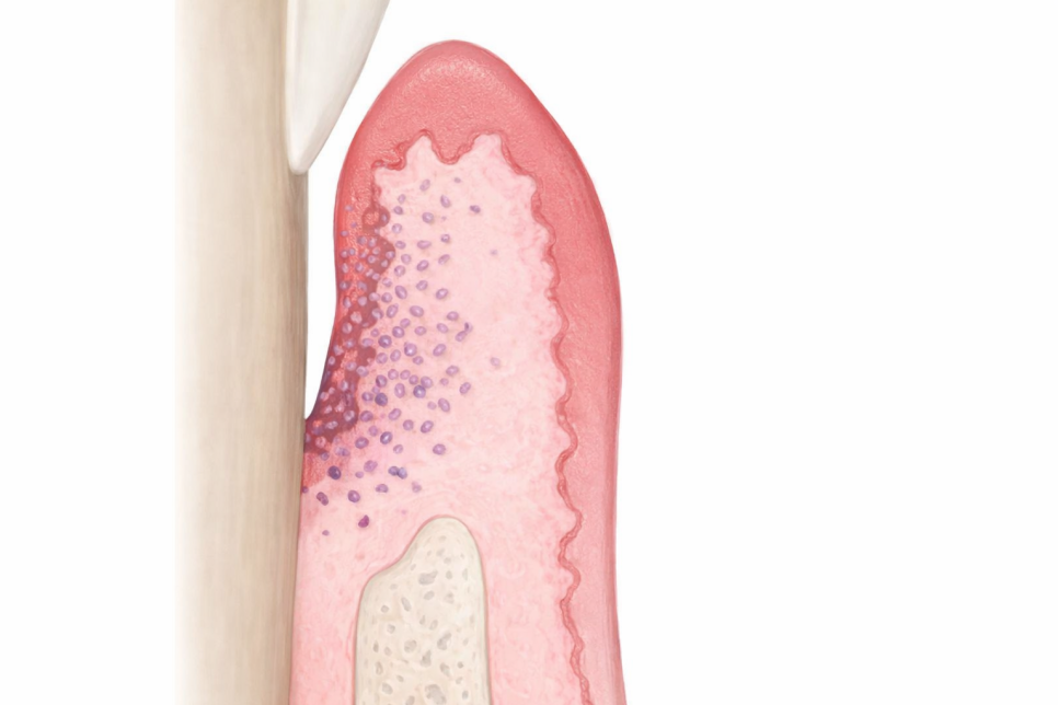당산동 치과 잇몸치료! 치근활택술 / 치주소파술이란? 관련 이미지 3