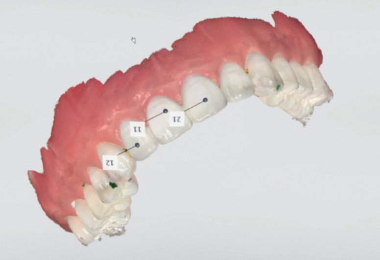 The Process of Creating Aesthetic Prosthetics Using a 3D Oral Scanner at the National Assembly Building Dental Clinic! image 7