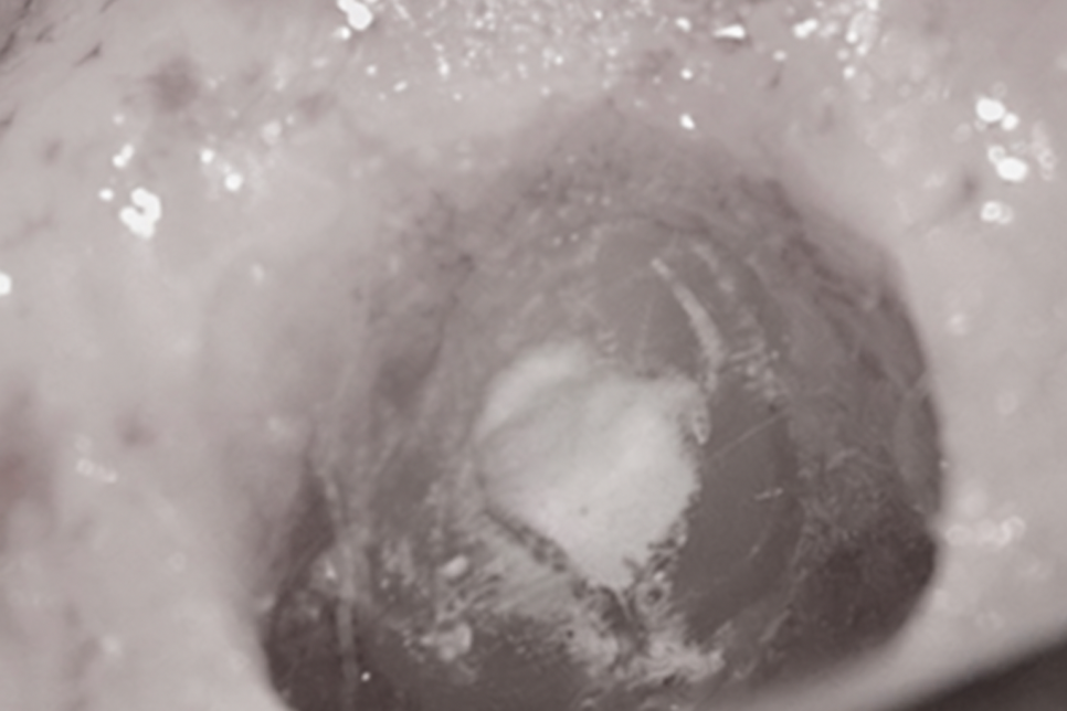 당산동 치과 신경치료 실패 후 치근단 절제술 Feat.미세 현미경 관련 이미지 6