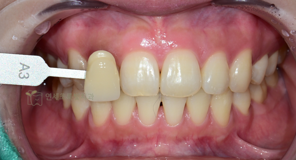 당산동 치과 원데이 화이트닝, 미백 치약보다 효능 확실한 이유는?! 관련 이미지 6