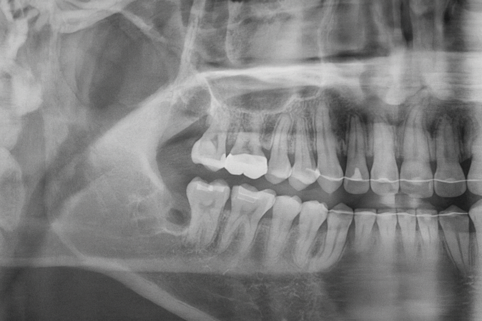 영등포동 치과 사랑니 발치 후 식사, 언제부터 가능할까? ft. 하치조 신경관 관련 이미지 5