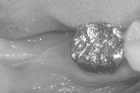 선유도역 치과 임플란트 수명은 잇몸이 결정한다?! Ft. 부착치은 관련 이미지 4