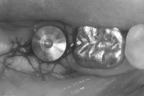 선유도역 치과 임플란트 수명은 잇몸이 결정한다?! Ft. 부착치은 관련 이미지 5