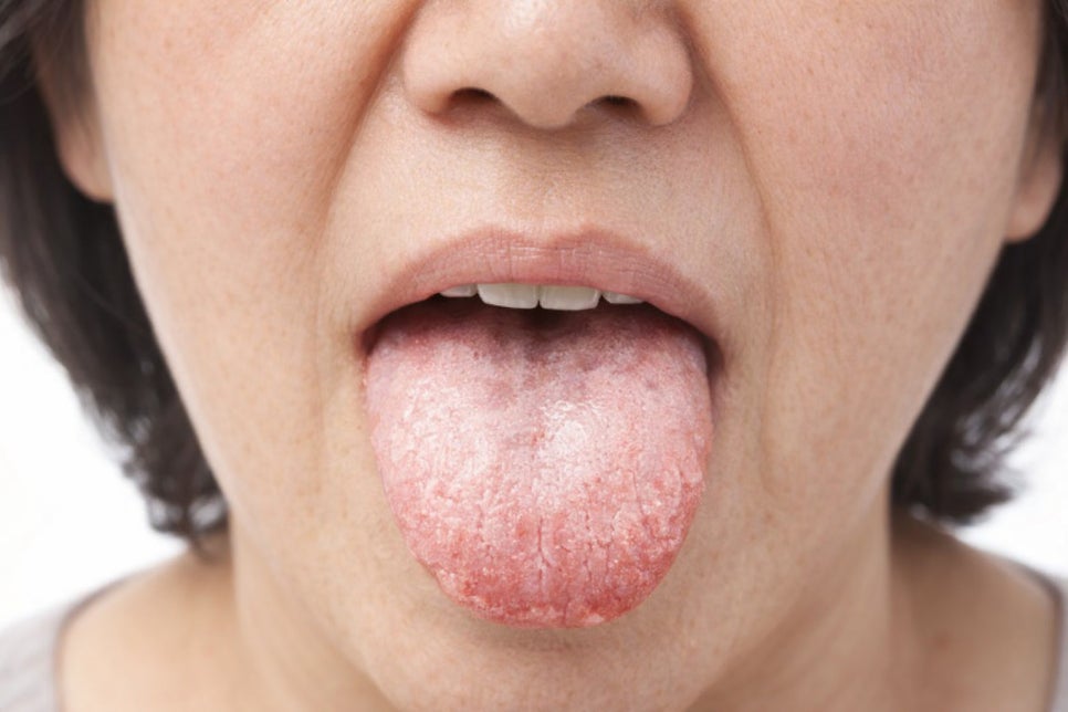 선유도 치과 다발성 우식증으로 이어질 수 있는 구강 건조증 어떻게 예방할 수 있을까? 관련 이미지 1