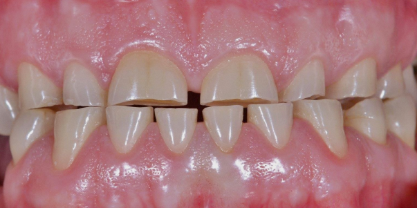 Yeongdeungpo-gu Office Station Dental Clinic: Tooth Wear—Is It Okay to Leave Teeth That Are Gradually Wearing Down Alone? image 3