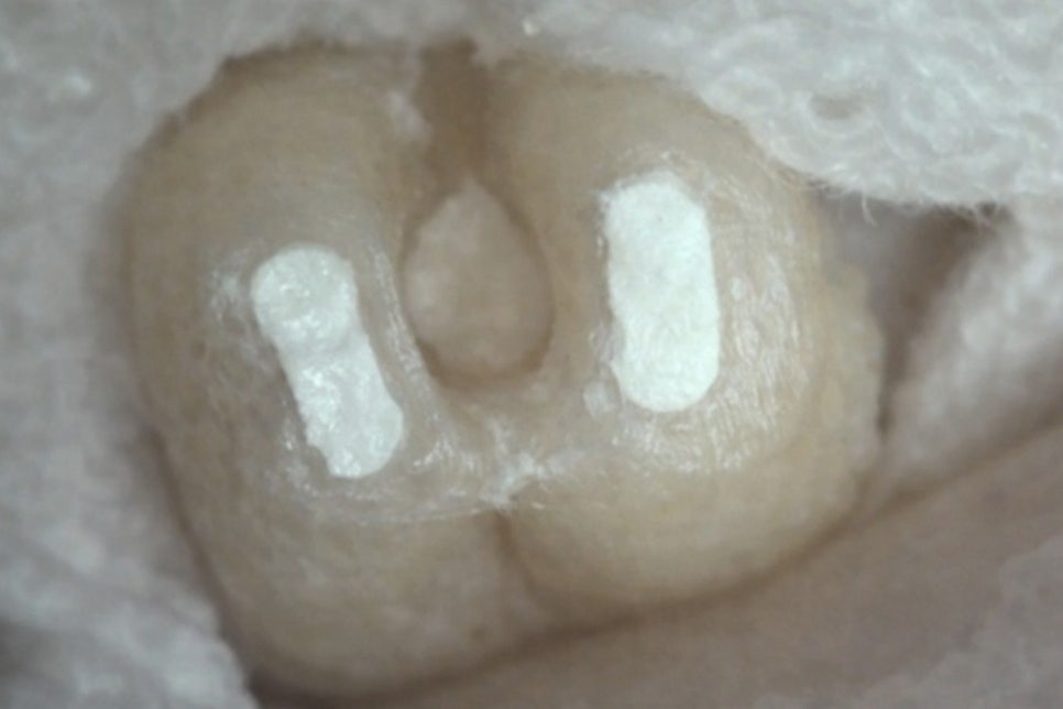 선유도 치과 에서 알려드리는 발치 전 자연치 살리는 마지막 치료 방법 치아재식술 관련 이미지 3