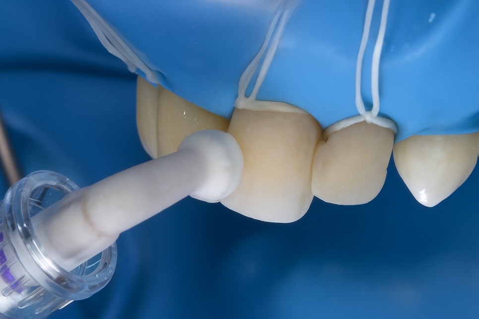 당산역 치과 아이콘 레진이란? : 치아 탈회 및 교정 치료 후 화이트 스팟 관련 이미지 6