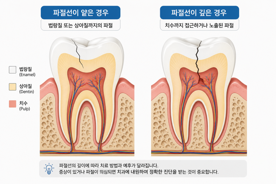 Does a Tooth Fracture at a Dangsan-dong Dental Clinic Always Require Root Canal Treatment? image 2