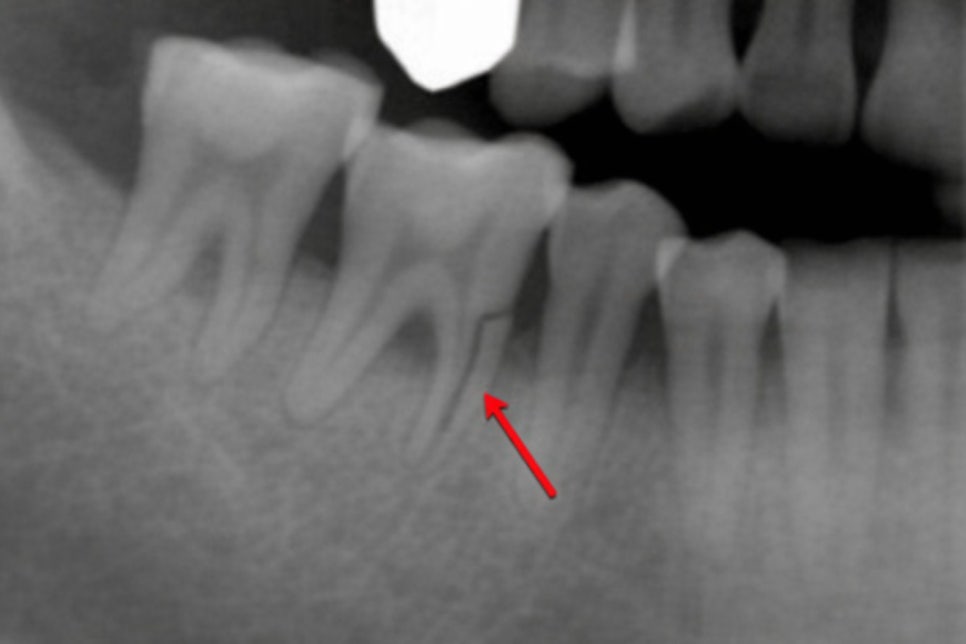 치아 크랙 방치하면 안 되는 이유 파절 증상부터 원인까지 당산 보존치과 에서 알려드립니다! 관련 이미지 5