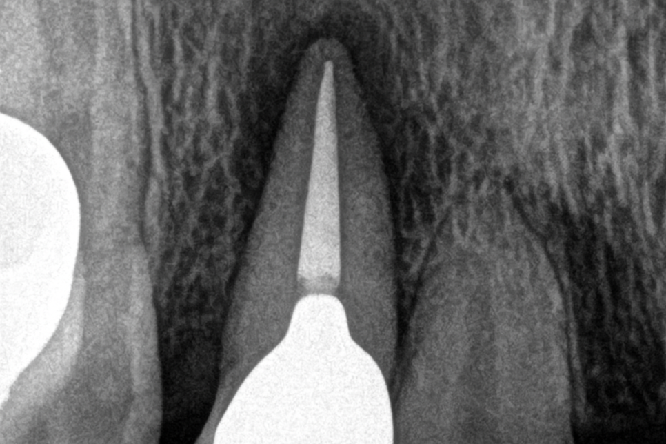 당산동 치과 신경치료 실패 후 치근단 절제술 Feat.미세 현미경 관련 이미지 4
