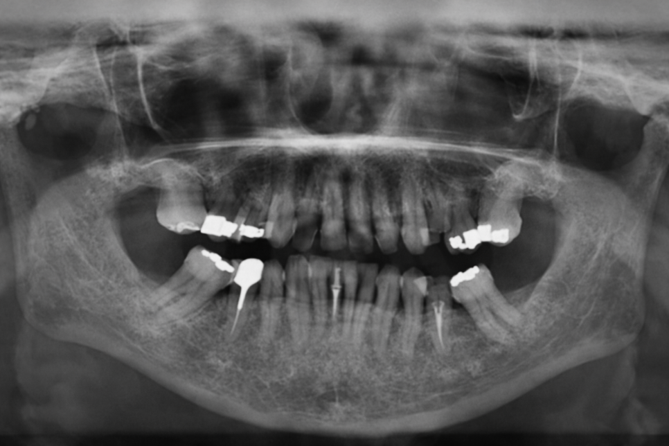 선유도역 치과 네이게이션 임플란트, 어떻게 진행될까? 관련 이미지 1