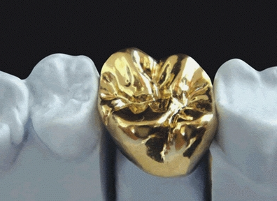 Why a Tooth Crown Is Needed After Root Canal Treatment at a Dental Clinic Near Yeongdeungpo-gu Office Station image 5
