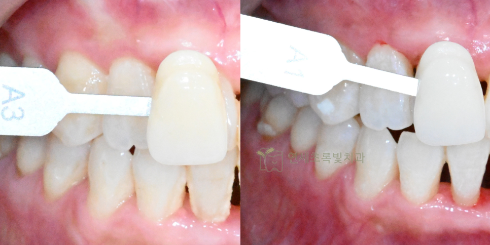 당산동 치과 원데이 화이트닝, 미백 치약보다 효능 확실한 이유는?! 관련 이미지 5