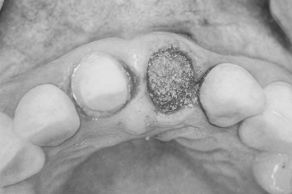 영등포구청역 치과 임플란트 수술 왜 기다렸다 하나요? ft. 발치와 보존술 관련 이미지 3