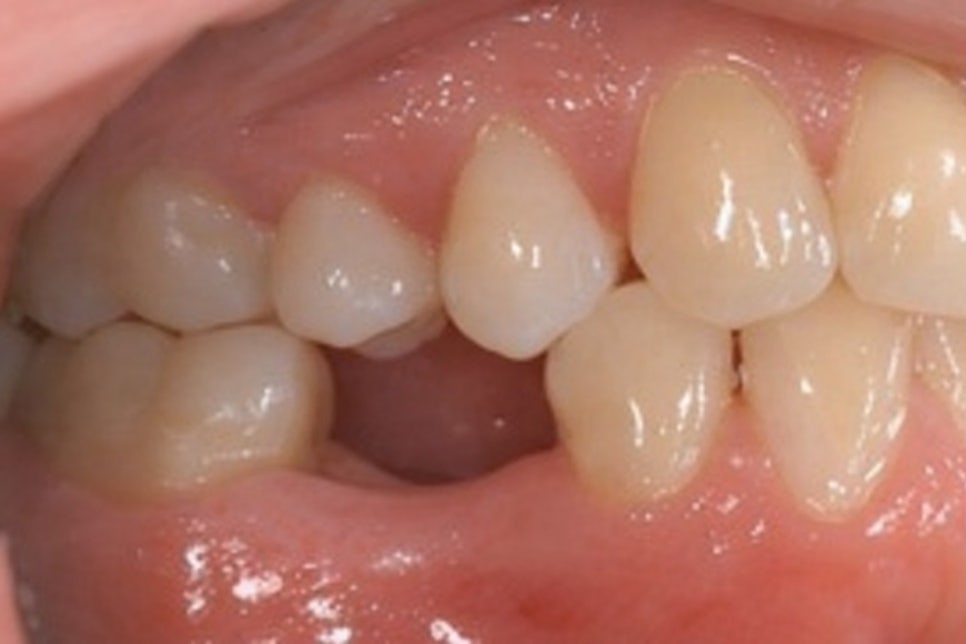 영등포구청역 치과 치아 상실 시 발생할 수 있는 구강 내 문제점은 무엇이 있을까? 관련 이미지 1